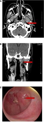 Reconstruction of nasopharyngeal defect with submental flap during surgery for nasopharyngeal malignant tumors
